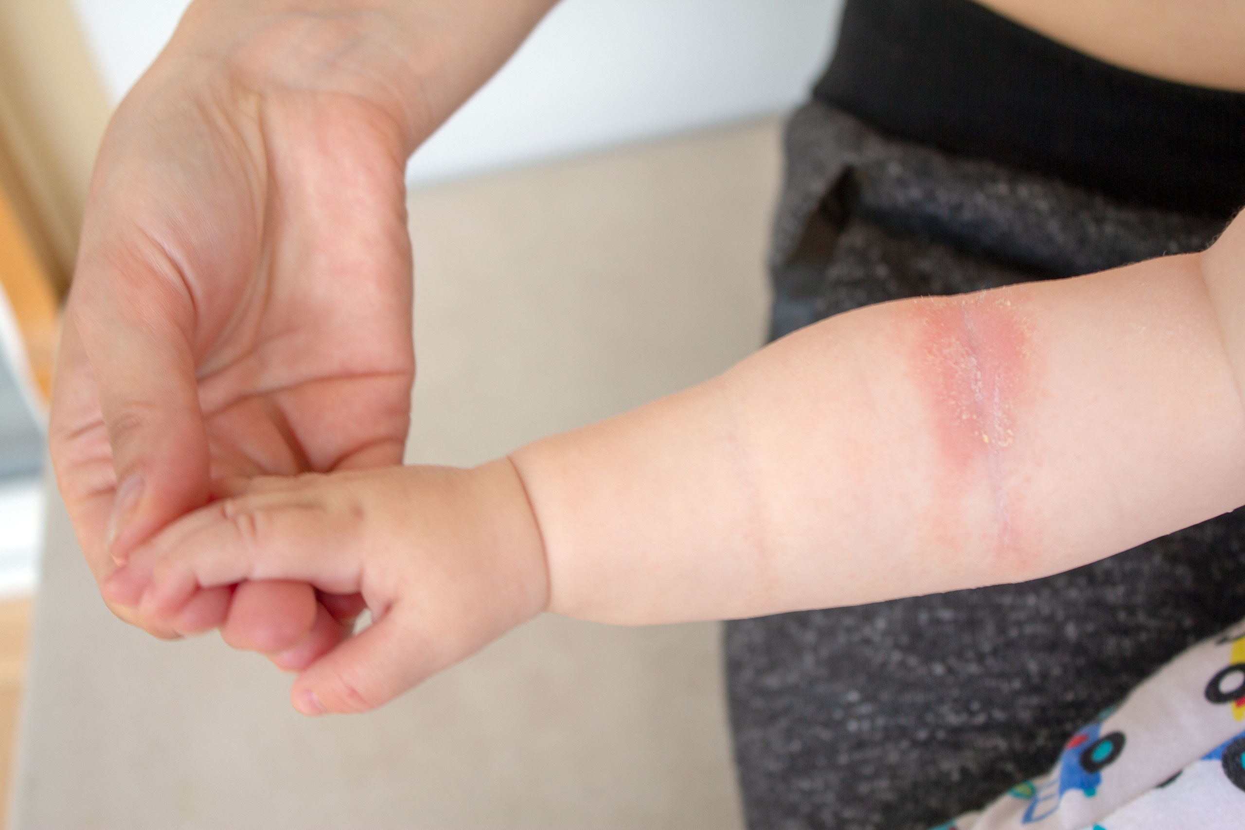 allcon-ratgeber-neurodermitis-baby-armbeuge