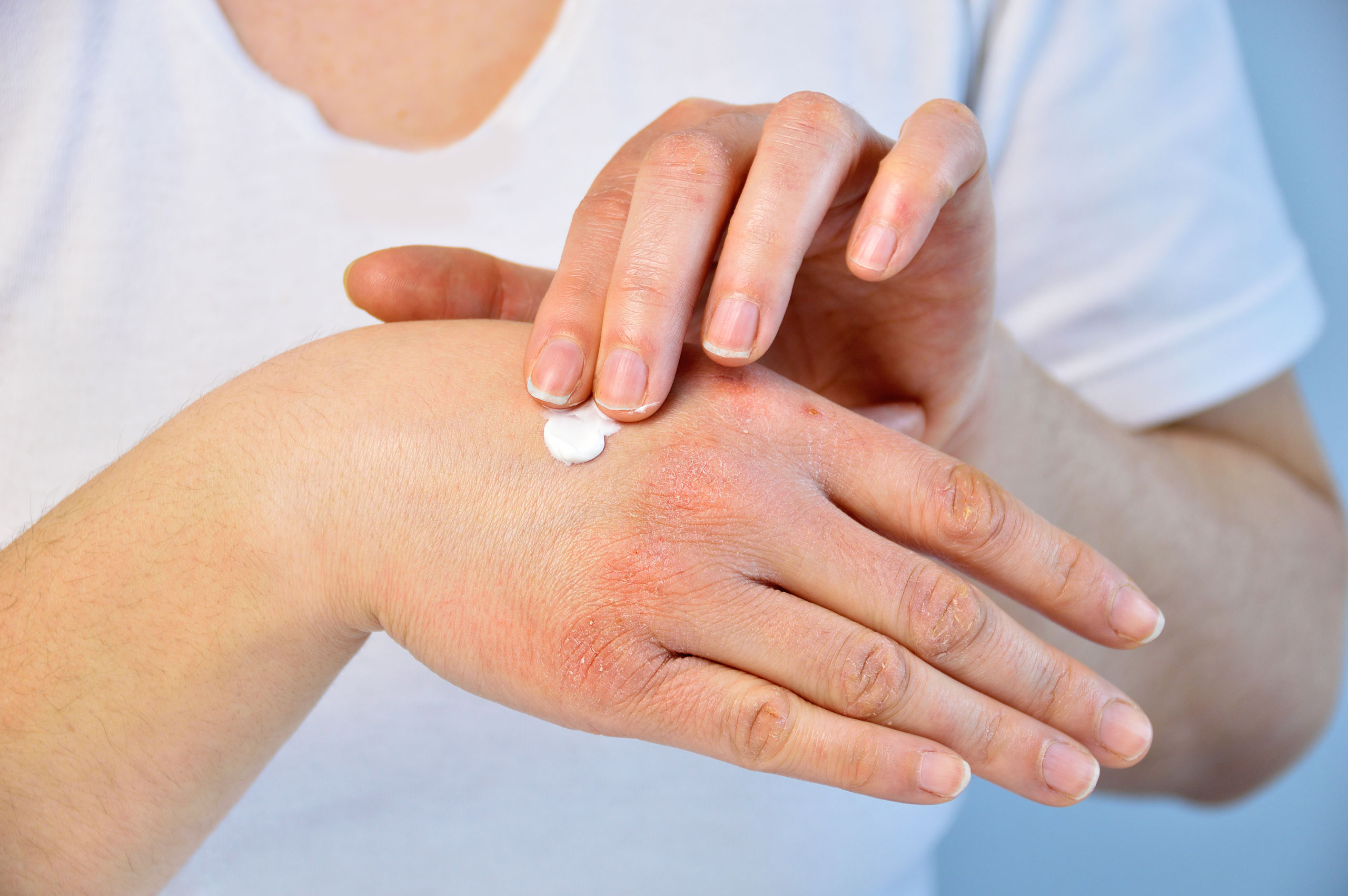 allcon-ratgeber-neurodermitis-hand-creme
