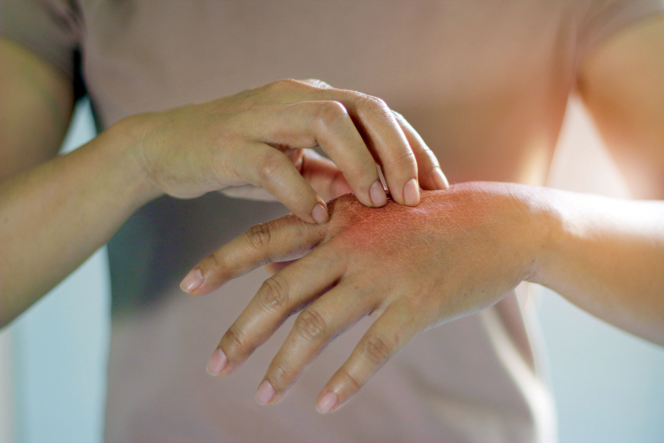 allcon-ratgeber-neurodermitis-symptome-ausschlag-hand