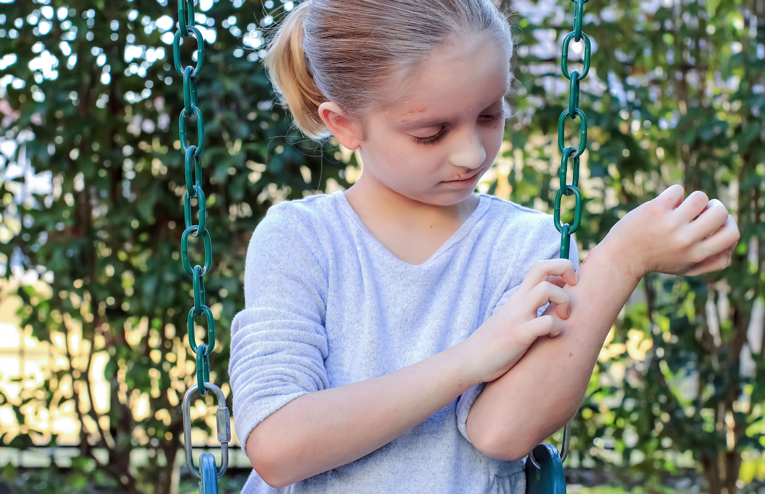 allcon-ratgeber-neurodermitis-bei-kindern-juckender-Haustausschlag-klein