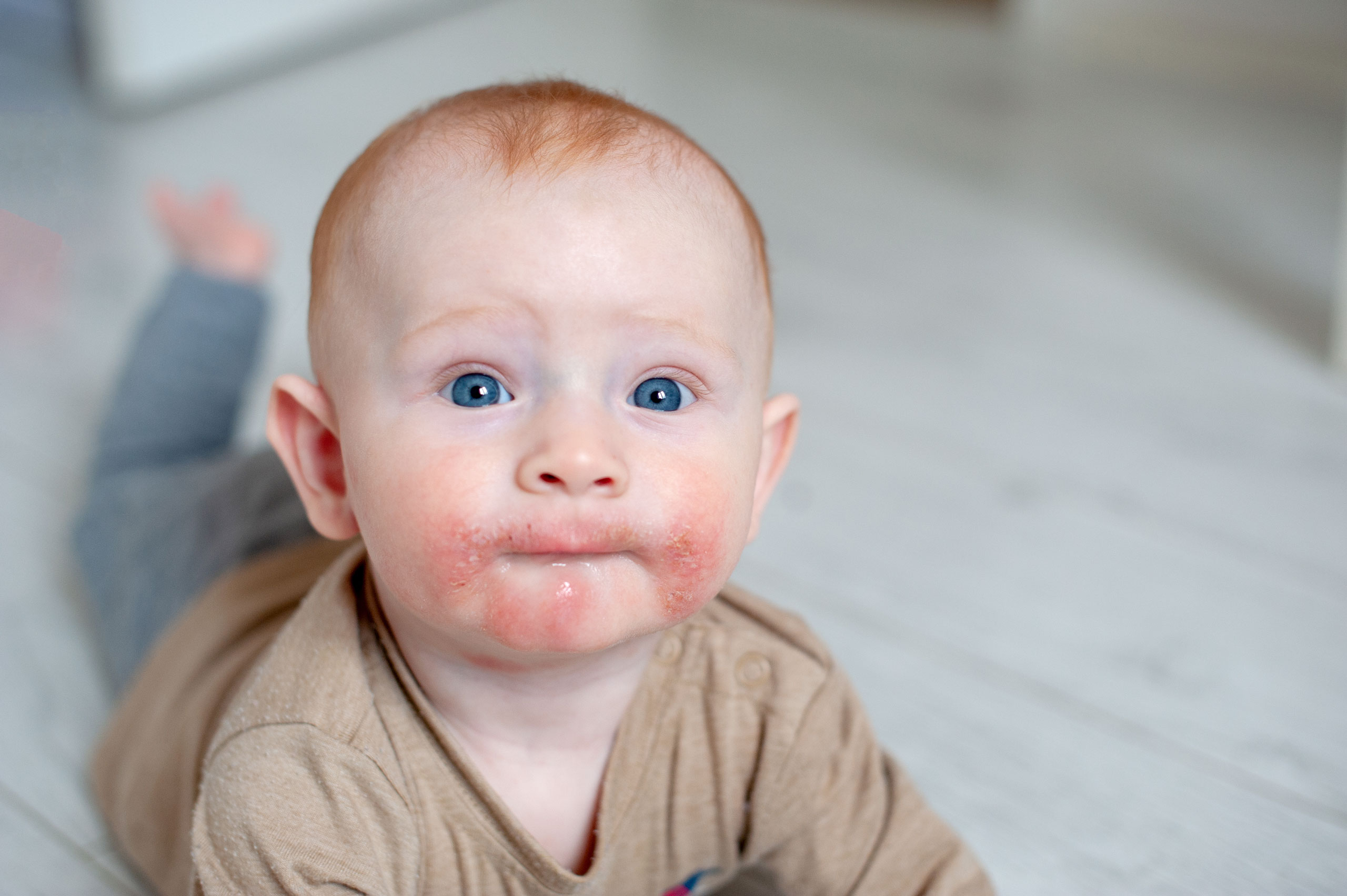 allcon-ratgeber-neurodermitis-baby-erkennen-ekzeme